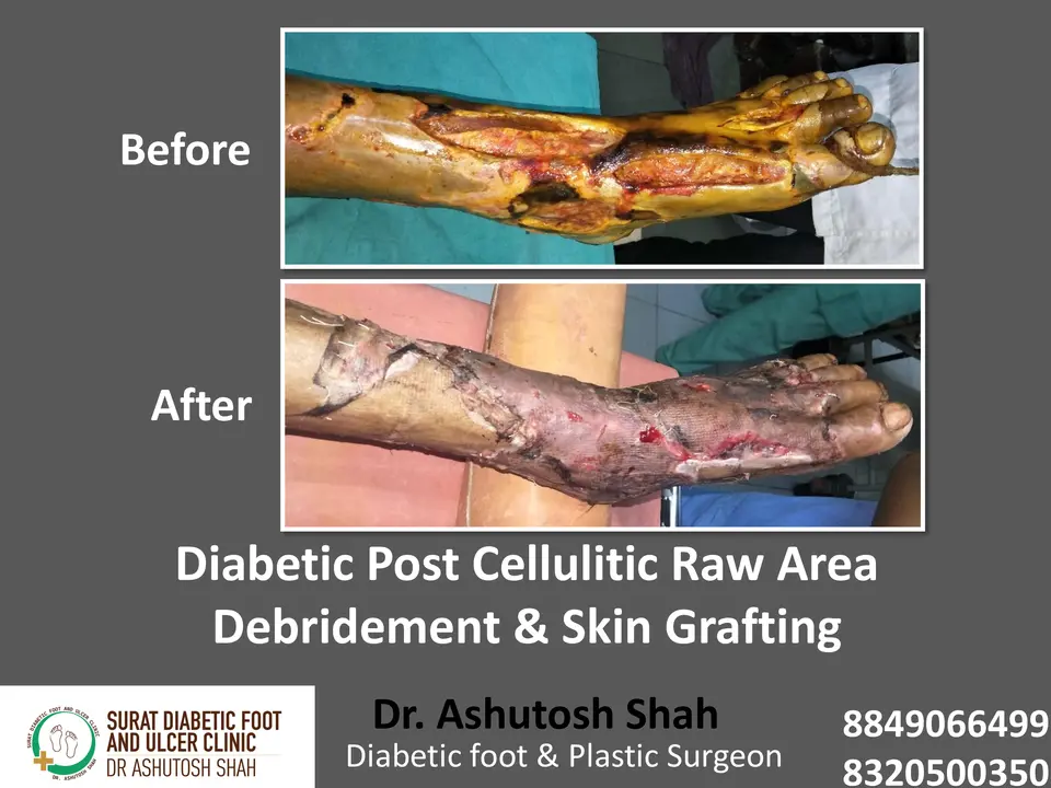 Diabetic Cellulitis and Coverage.pptx-11.webp